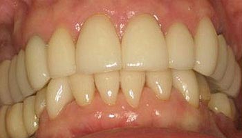 The image shows a close-up view of a person s teeth with yellowish stains, indicating possible dental issues such as tooth decay or discoloration.