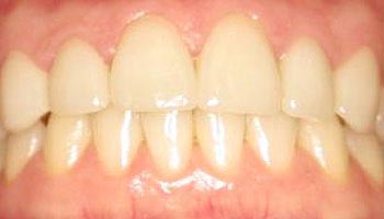 The image shows a close-up view of an individual s teeth with yellowing, indicating dental decay or discoloration.