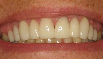 A man s mouth showing a wide smile with white teeth and gums.