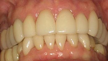 The image shows a close-up of a person s mouth with teeth that appear discolored and possibly damaged, with the upper lip partially visible.