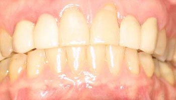 The image shows a close-up of a person s mouth with teeth that appear discolored and yellowed, likely due to staining or decay.