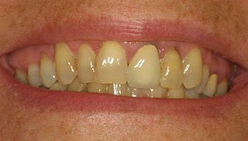 The image shows a close-up of a person s mouth with yellowed teeth and an expression of a smile, against a neutral background.