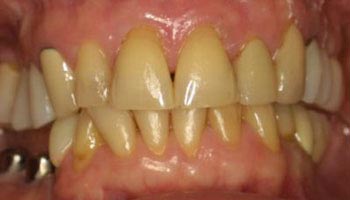 The image shows a close-up of a person s teeth with an unhealthy appearance, likely due to decay or staining, against a plain background.